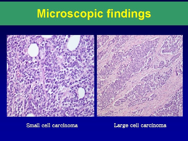 Microscopic findings Small cell carcinoma Large cell carcinoma 