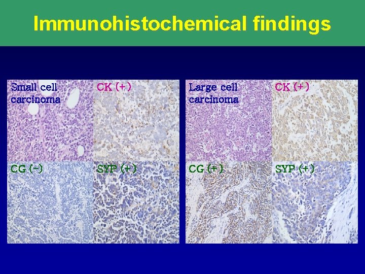 Immunohistochemical findings Small cell carcinoma CK (+) Large cell carcinoma CK (+) CG (-)