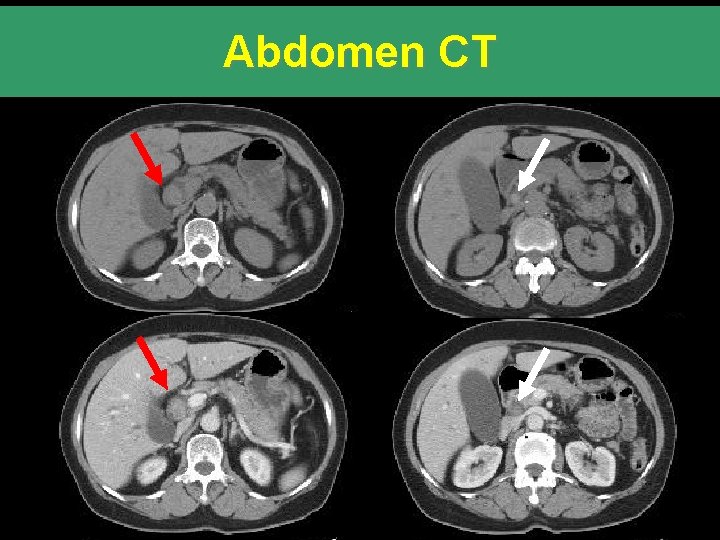 Abdomen CT 