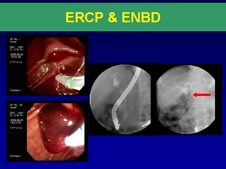 ERCP & ENBD 