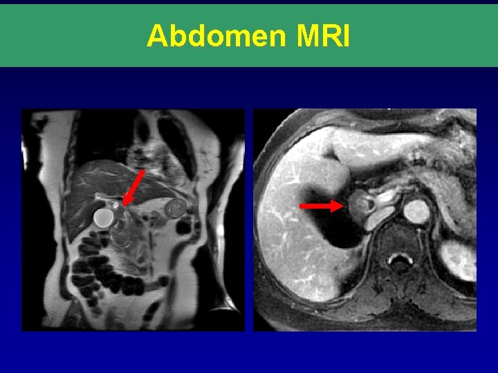 Abdomen MRI 