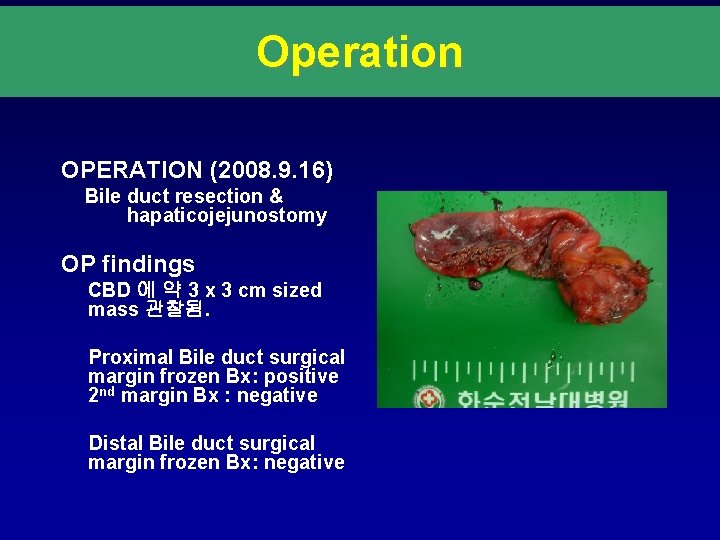 Operation OPERATION (2008. 9. 16) Bile duct resection & hapaticojejunostomy OP findings CBD 에