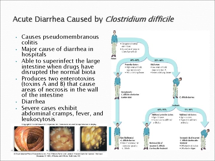 Acute Diarrhea Caused by Clostridium difficile • • • Causes pseudomembranous colitis Major cause
