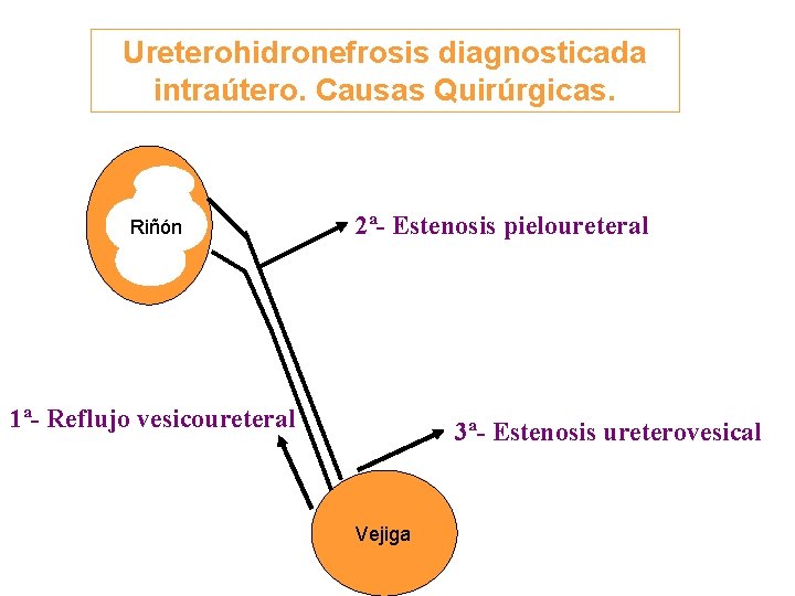Ureterohidronefrosis diagnosticada intraútero. Causas Quirúrgicas. Riñón 2ª- Estenosis pieloureteral 1ª- Reflujo vesicoureteral 3ª- Estenosis