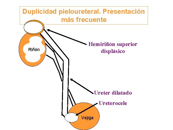 Duplicidad pieloureteral. Presentación más frecuente Riñón Hemiriñón superior displásico Ureter dilatado Ureterocele Vejiga 