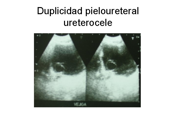 Duplicidad pieloureteral ureterocele 