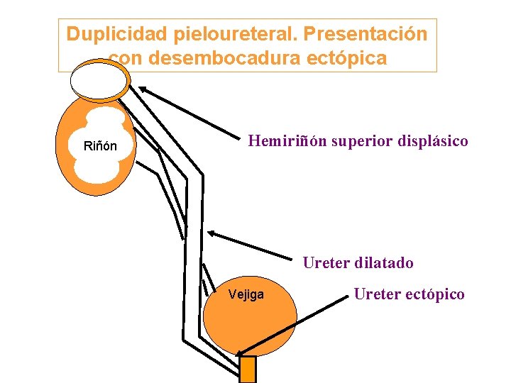 Duplicidad pieloureteral. Presentación con desembocadura ectópica Riñón Hemiriñón superior displásico Ureter dilatado Vejiga Ureter