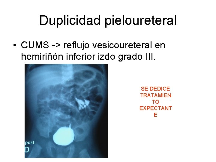 Duplicidad pieloureteral • CUMS -> reflujo vesicoureteral en hemiriñón inferior izdo grado III. SE