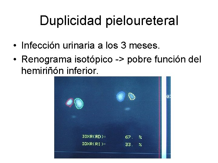 Duplicidad pieloureteral • Infección urinaria a los 3 meses. • Renograma isotópico -> pobre