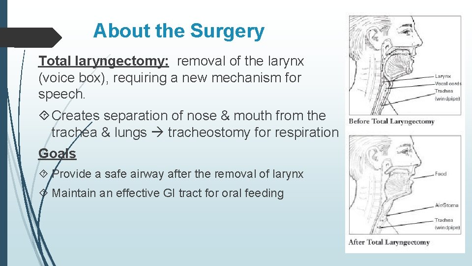 About the Surgery Total laryngectomy: removal of the larynx (voice box), requiring a new