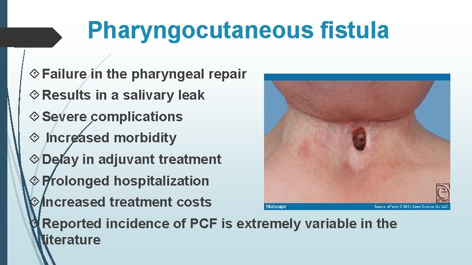 Pharyngocutaneous fistula Failure in the pharyngeal repair Results in a salivary leak Severe complications