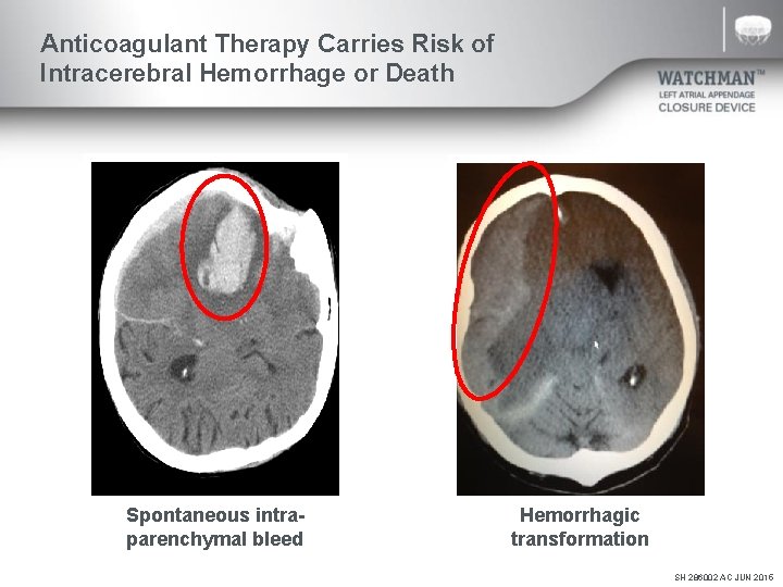 Anticoagulant Therapy Carries Risk of Intracerebral Hemorrhage or Death Spontaneous intraparenchymal bleed Hemorrhagic transformation