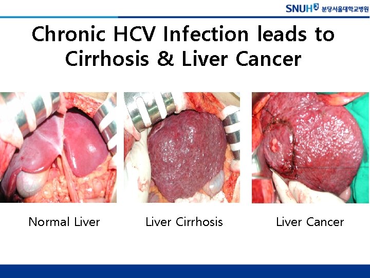 Chronic HCV Infection leads to Cirrhosis & Liver Cancer Normal Liver Cirrhosis Liver Cancer