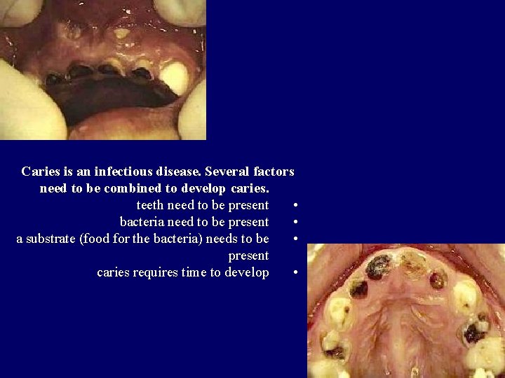 Caries is an infectious disease. Several factors need to be combined to develop caries.