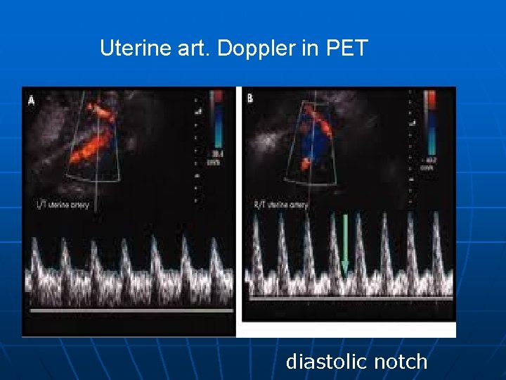 Uterine art. Doppler in PET diastolic notch 