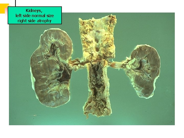 Kidneys, left side normal size right side atrophy 