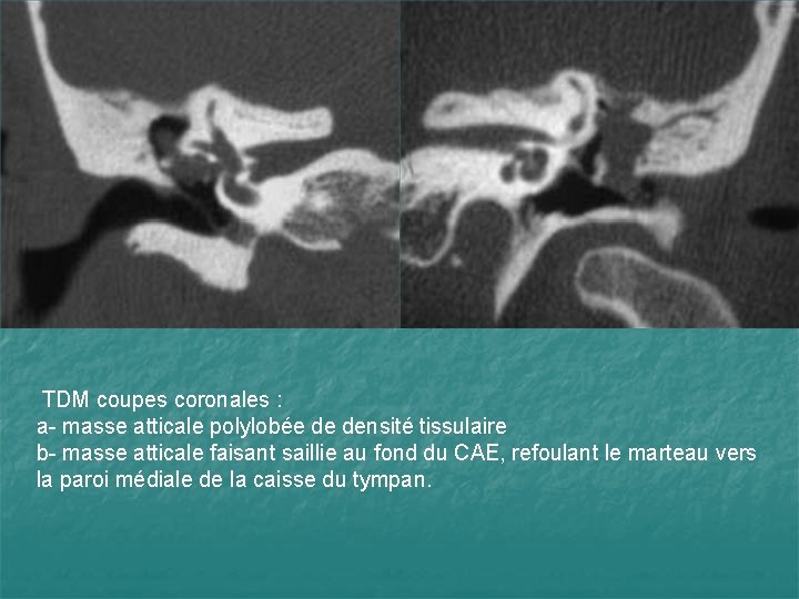 TDM coupes coronales : a- masse atticale polylobée de densité tissulaire b- masse atticale