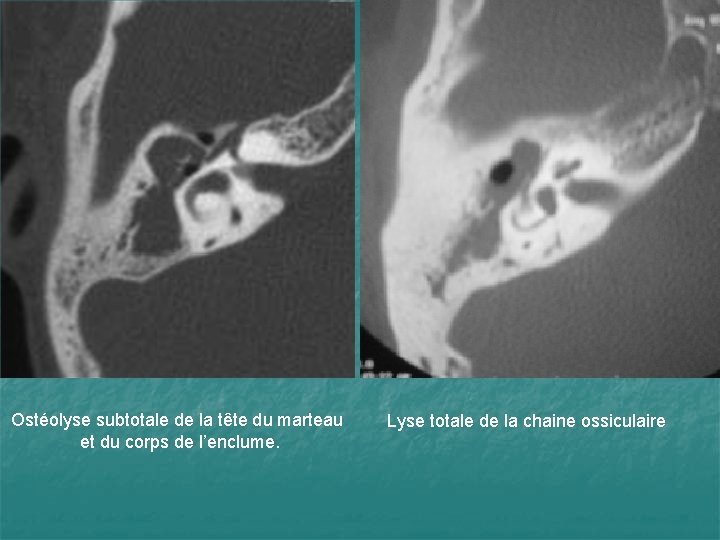 Ostéolyse subtotale de la tête du marteau et du corps de l’enclume. Lyse totale