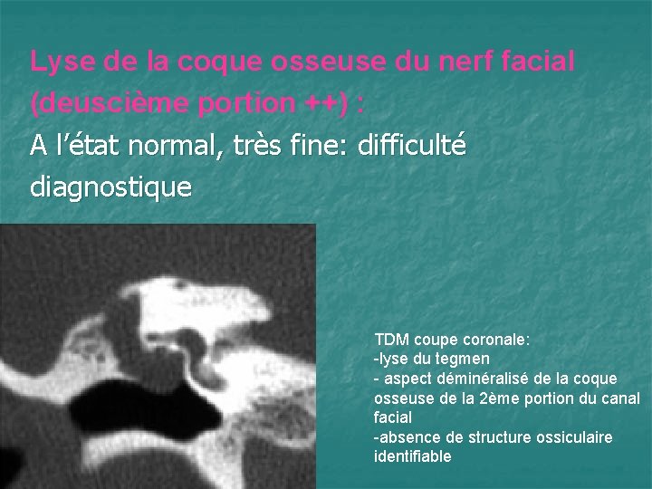 Lyse de la coque osseuse du nerf facial (deuscième portion ++) : A l’état