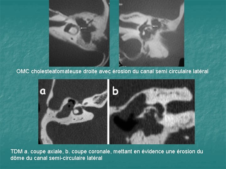 OMC cholesteatomateuse droite avec érosion du canal semi circulaire latéral TDM a. coupe axiale,