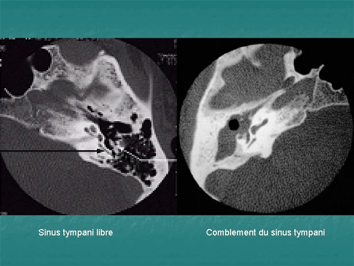 Sinus tympani libre Comblement du sinus tympani 