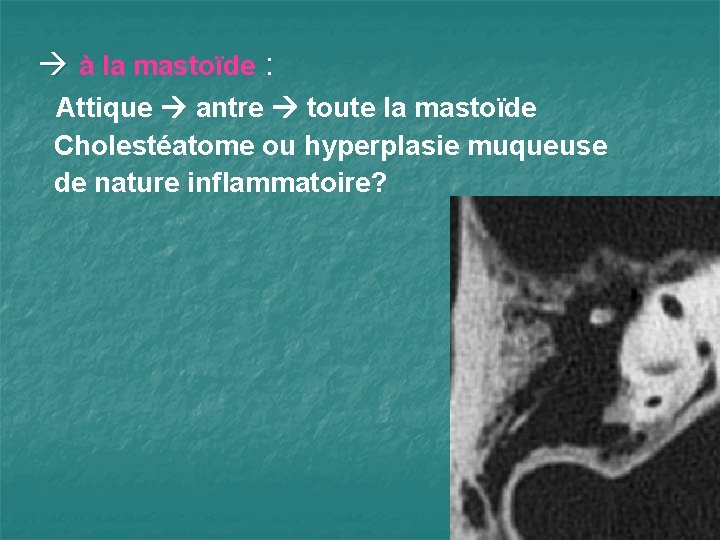  à la mastoïde : Attique antre toute la mastoïde Cholestéatome ou hyperplasie muqueuse