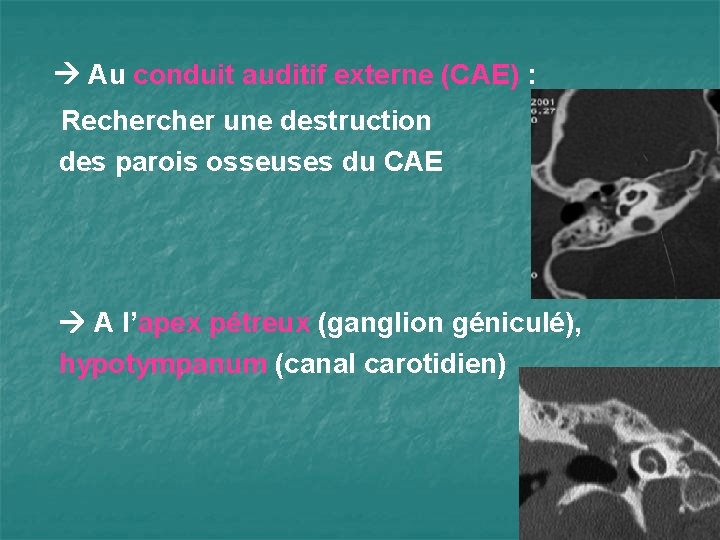  Au conduit auditif externe (CAE) : Recher une destruction des parois osseuses du