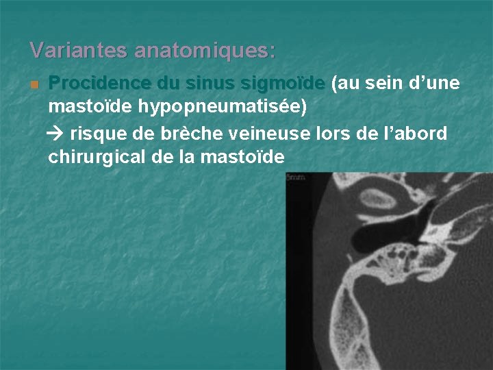 Variantes anatomiques: n Procidence du sinus sigmoïde (au sein d’une mastoïde hypopneumatisée) risque de