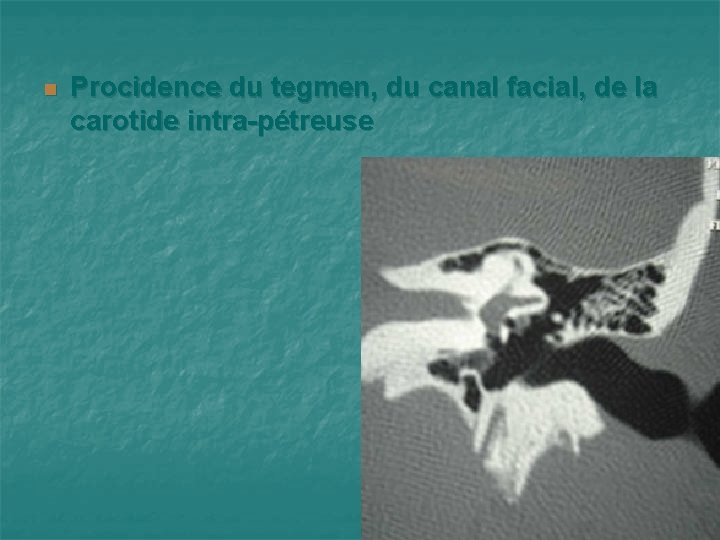 n Procidence du tegmen, du canal facial, de la carotide intra-pétreuse 