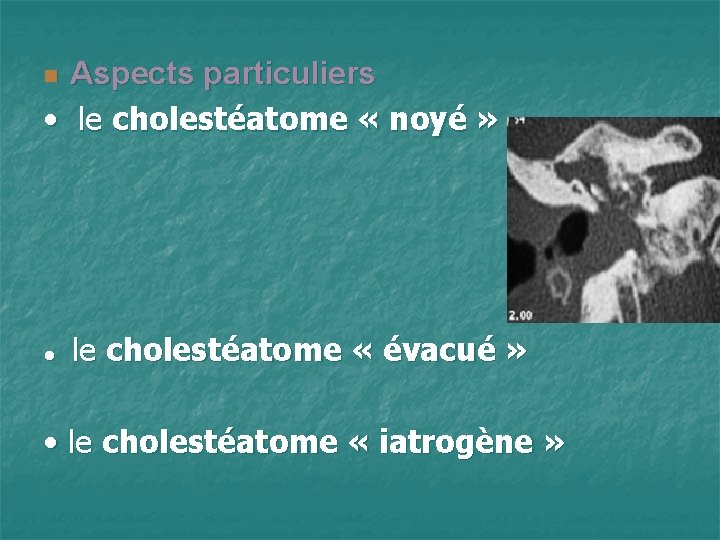 Aspects particuliers • le cholestéatome « noyé » n ● le cholestéatome « évacué