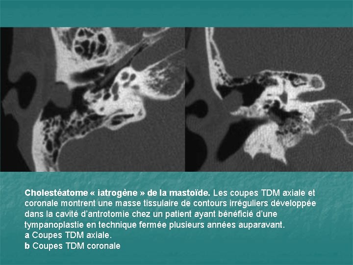 Cholestéatome « iatrogène » de la mastoïde. Les coupes TDM axiale et coronale montrent