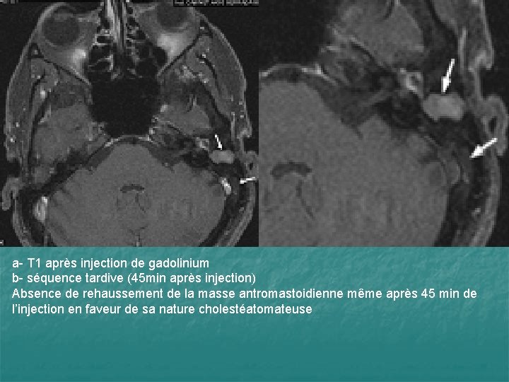 a- T 1 après injection de gadolinium b- séquence tardive (45 min après injection)