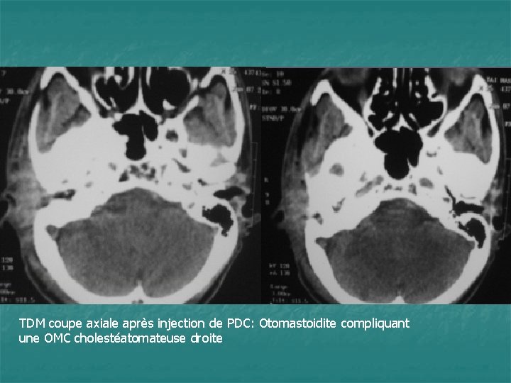 TDM coupe axiale après injection de PDC: Otomastoidite compliquant une OMC cholestéatomateuse droite 