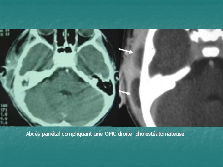Abcès pariétal compliquant une OMC droite cholestéatomateuse 
