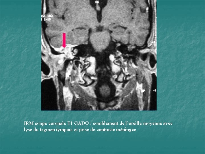 IRM coupe coronale T 1 GADO : comblement de l’oreille moyenne avec lyse du