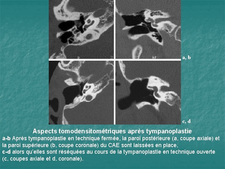 a, b c, d Aspects tomodensitométriques après tympanoplastie a-b Après tympanoplastie en technique fermée,