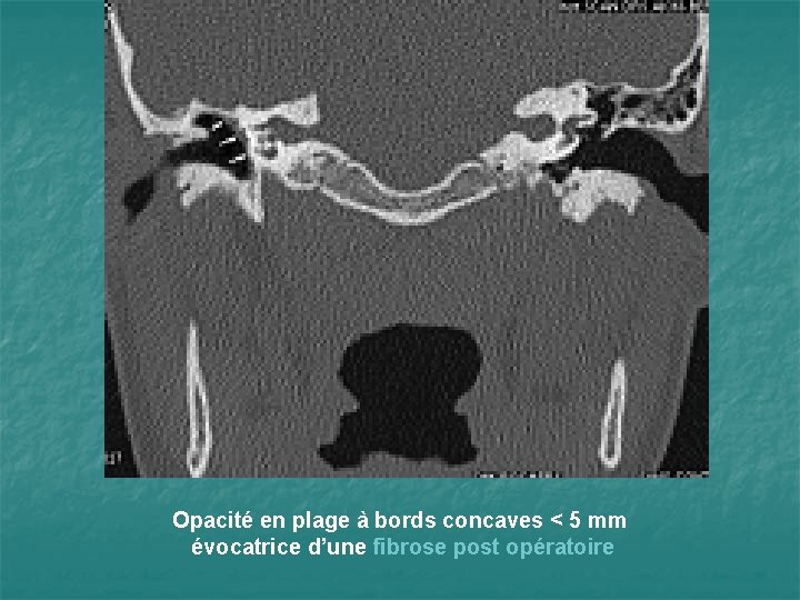 Opacité en plage à bords concaves < 5 mm évocatrice d’une fibrose post opératoire