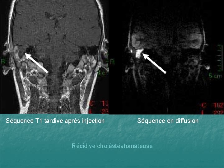 Séquence T 1 tardive après injection Séquence en diffusion Récidive choléstéatomateuse 