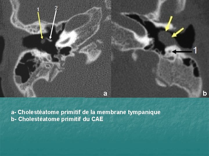 a a- Cholestéatome primitif de la membrane tympanique b- Cholestéatome primitif du CAE b