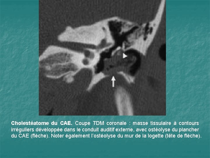 Cholestéatome du CAE. Coupe TDM coronale : masse tissulaire à contours irréguliers développée dans