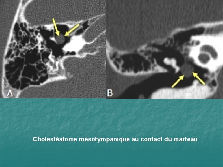 Cholestéatome mésotympanique au contact du marteau 