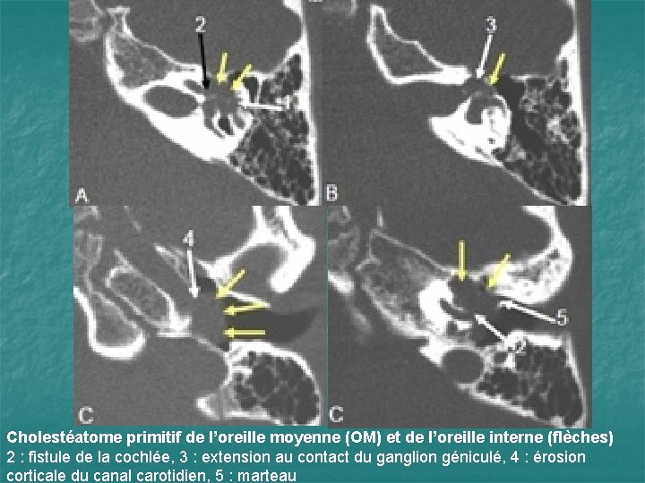 Cholestéatome primitif de l’oreille moyenne (OM) et de l’oreille interne (flèches) 2 : fistule