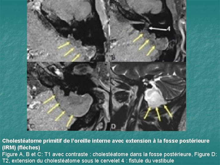 Cholestéatome primitif de l’oreille interne avec extension à la fosse postérieure (IRM) (flèches) Figure