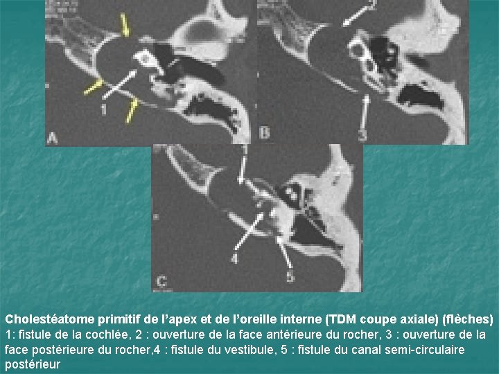 Cholestéatome primitif de l’apex et de l’oreille interne (TDM coupe axiale) (flèches) 1: fistule