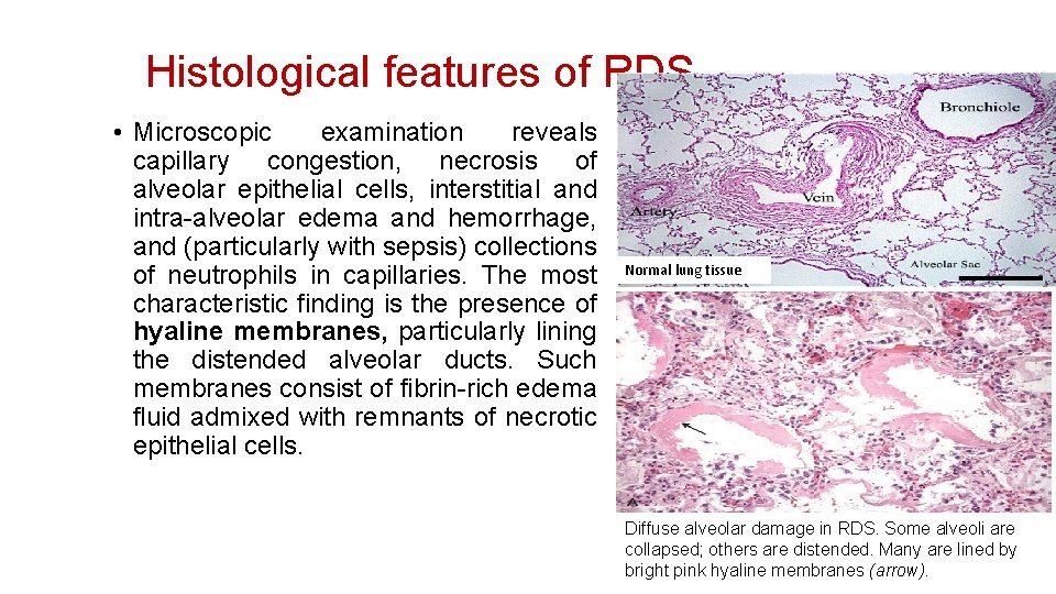 Histological features of RDS • Microscopic examination reveals capillary congestion, necrosis of alveolar epithelial