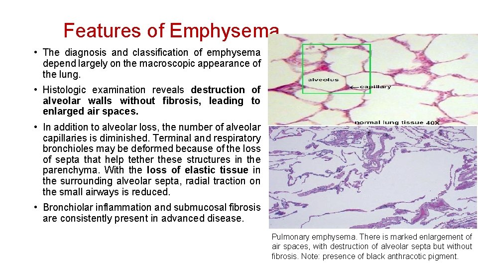 Features of Emphysema • The diagnosis and classification of emphysema depend largely on the