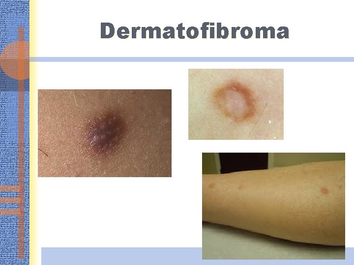 Dermatofibroma 