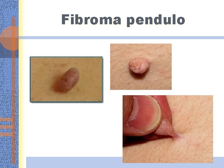Fibroma pendulo 