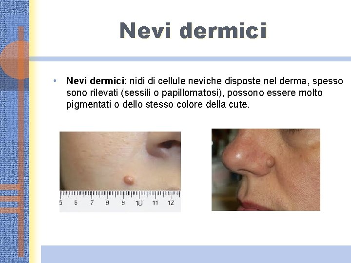 Nevi dermici • Nevi dermici: nidi di cellule neviche disposte nel derma, spesso sono