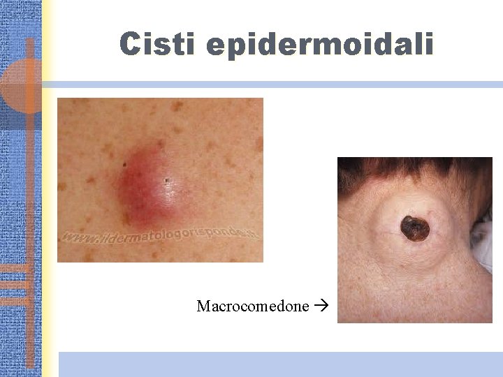 Cisti epidermoidali Macrocomedone 